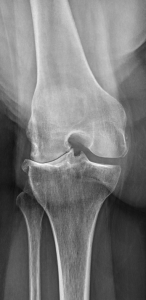 Arthrose fémoro-tibiale externe ayant justifiée un changement de prothèse a 15 ans de la prothèse uni compartimentale