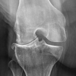 Arthrose fémoro-tibiale externe ayant justifiée un changement de prothèse a 15 ans de la prothèse uni compartimentale